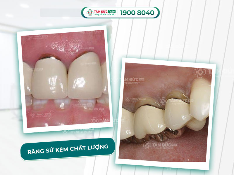 TOP 5 HÌNH ẢNH BỌC RĂNG SỨ GIÁ RẺ, KÉM CHẤT LƯỢNG GÂY ẢNH HƯỞNG NGHIÊM TRỌNG