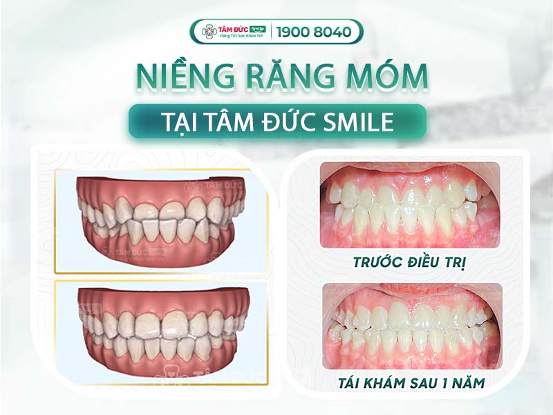 HÌNH ẢNH NIỀNG RĂNG MÓM TRƯỚC VÀ SAU KHI THÁO NIỀNG TẠI NHA KHOA TÂM ĐỨC SMILE