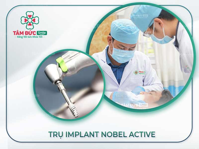 TRỒNG RĂNG VỚI TRỤ IMPLANT NOBEL ACTIVE MỸ NHANH LÀNH VÀ AN TOÀN