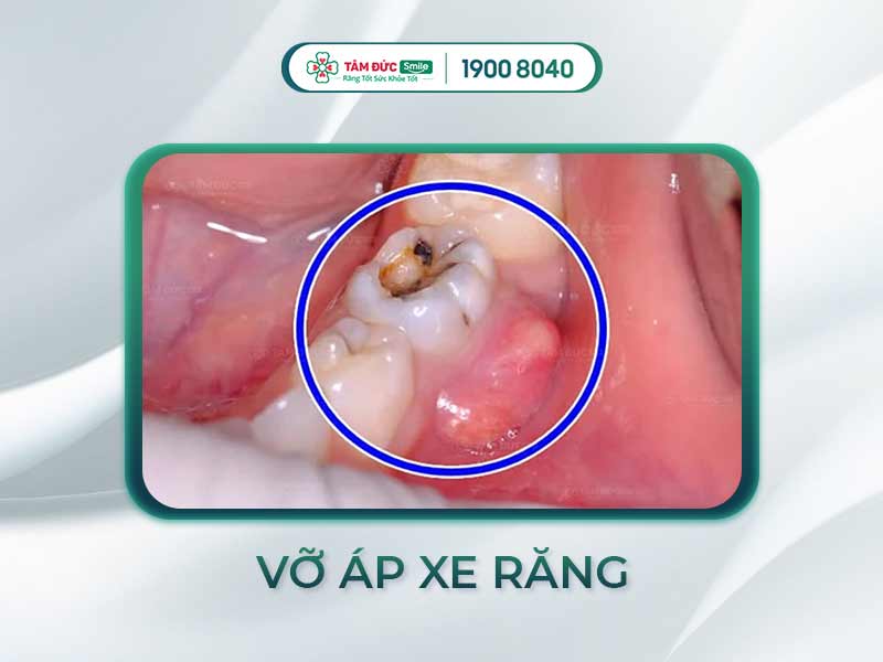 LÀM GÌ KHI BỊ VỠ ÁP XE RĂNG? CÁCH CHỮA ÁP XE RĂNG TRIỆT ĐỂ