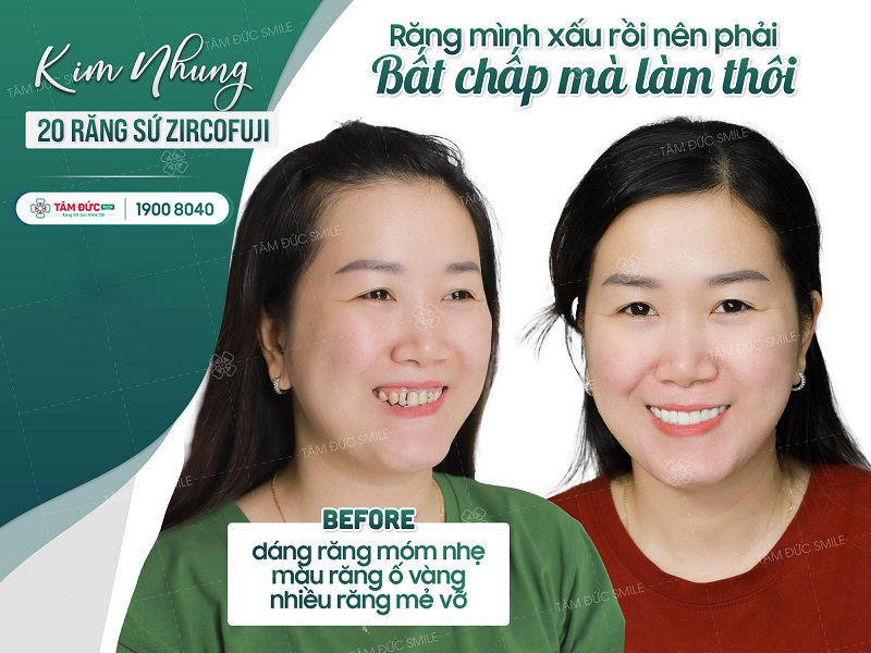 LÀM RĂNG SỨ Ở ĐÂU TỐT TẠI TPHCM?