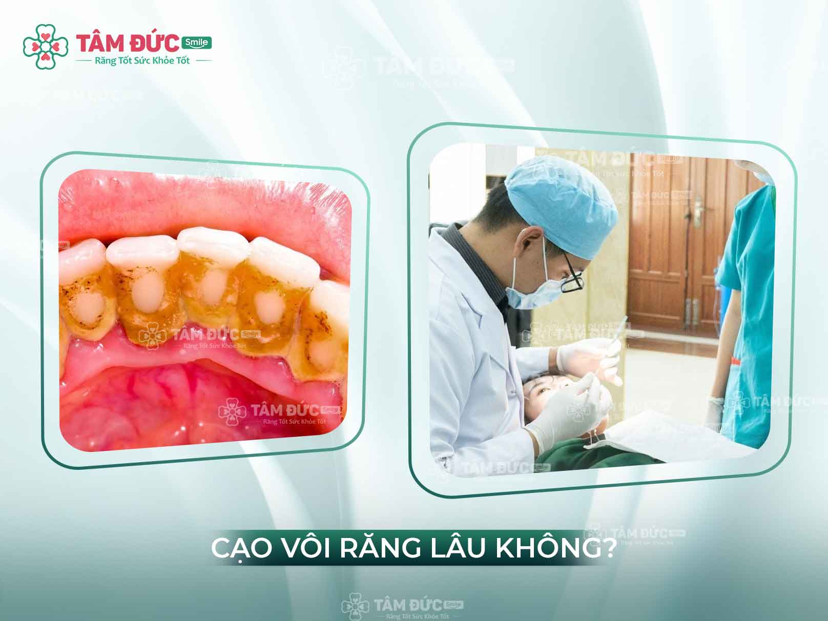 LẤY CAO RĂNG MẤT BAO LÂU? ĐỊA CHỈ NHA KHOA LẤY CAO RĂNG UY TÍN, GIÁ TỐT 