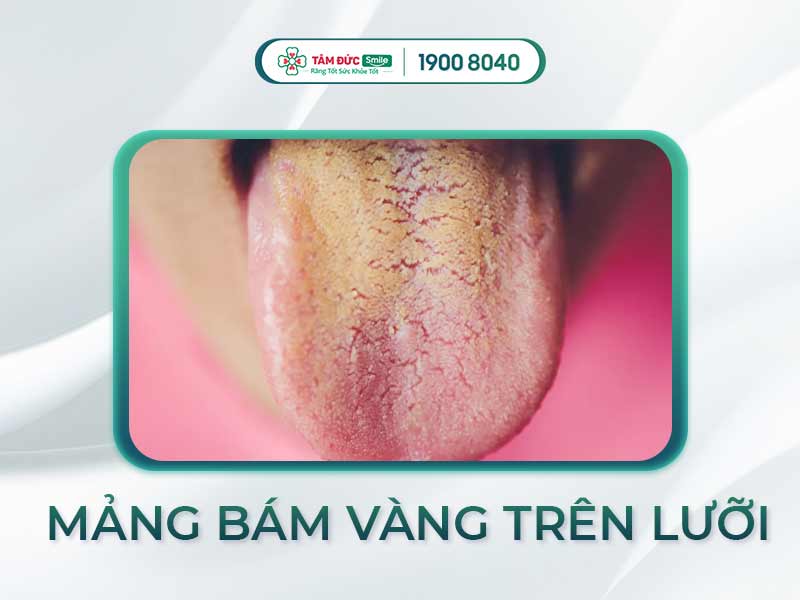 LƯỠI CÓ MẢNG BÁM MÀU VÀNG LÀ DẤU HIỆU CỦA BỆNH GÌ?
