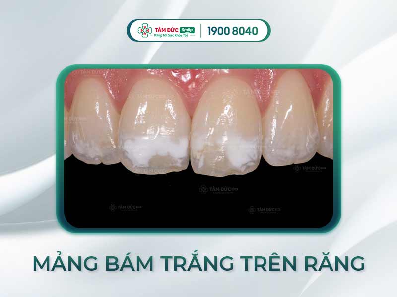 MẢNG BÁM TRẮNG TRÊN RĂNG LÀ GÌ? LÀM SAO ĐỂ LOẠI BỎ VĨNH VIỄN?