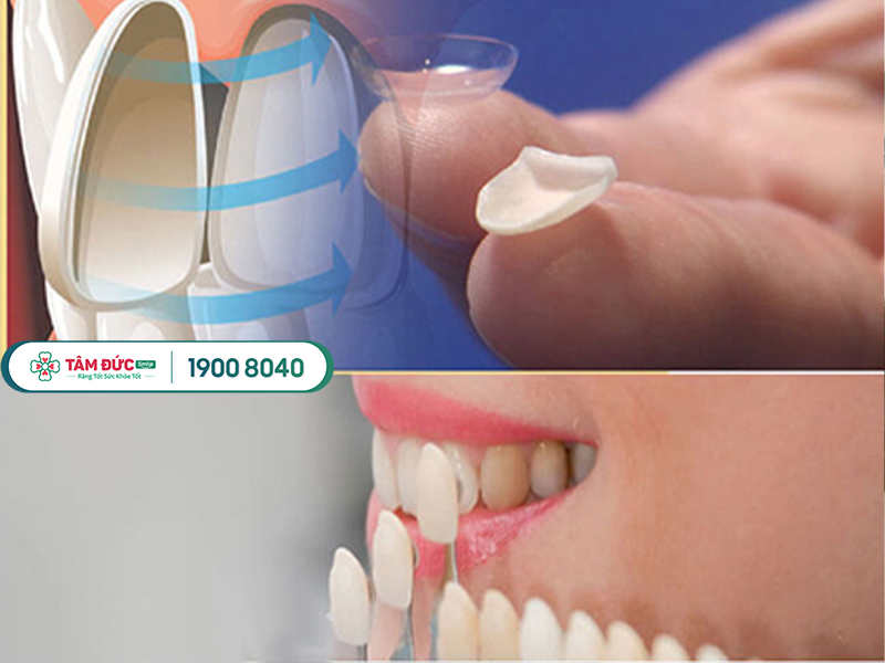Mặt Dán Sứ Veneer - Giải Pháp Bọc Răng Sứ Thời Thượng Và Cao Cấp