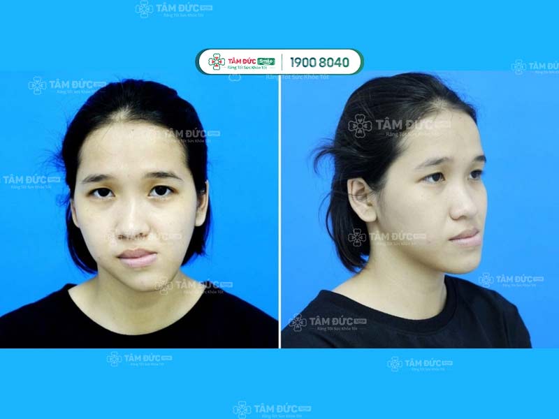 thói quen nhai một bên làm tăng nguy cơ bị lệch mặt