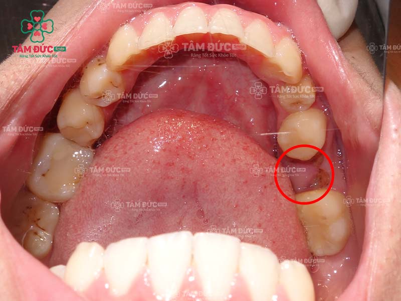 hàm răng đã bị mất răng số 6