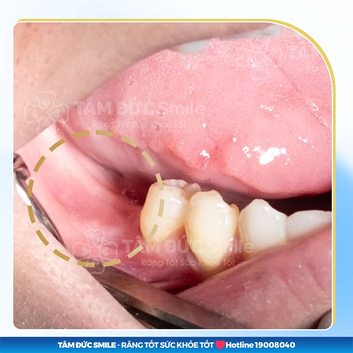 MẤT RĂNG SỐ 7 HÀM DƯỚI: PHƯƠNG PHÁP ĐIỀU TRỊ VÀ NHỮNG LƯU Ý