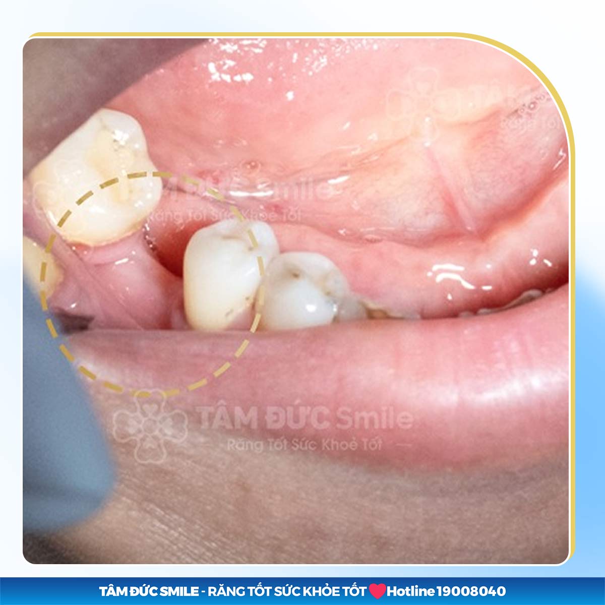 MẤT RĂNG SỐ 6 PHỤC HÌNH BẰNG CÁCH NÀO HIỆU QUẢ HIỆN NAY