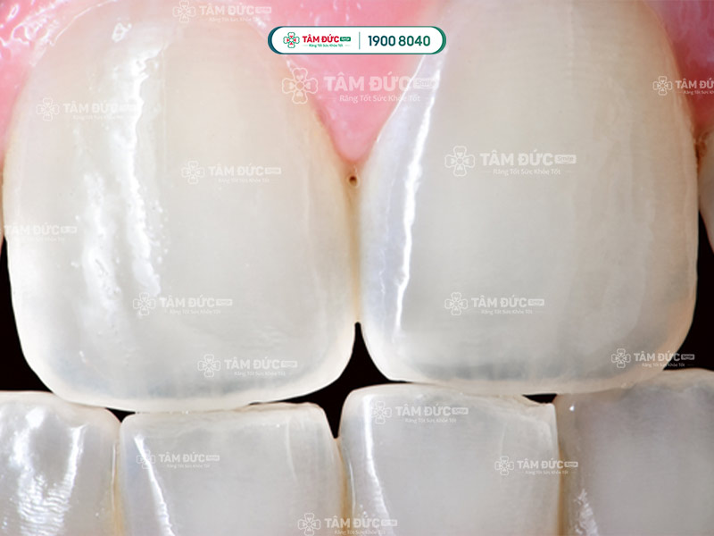 men răng là gì men răng bị yếu