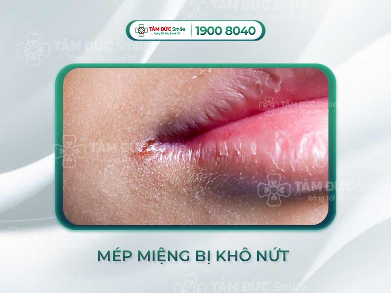 MÉP MIỆNG BỊ KHÔ NỨT PHẢI LÀM SAO? HƯỚNG DẪN CÁCH PHÒNG TRÁNH