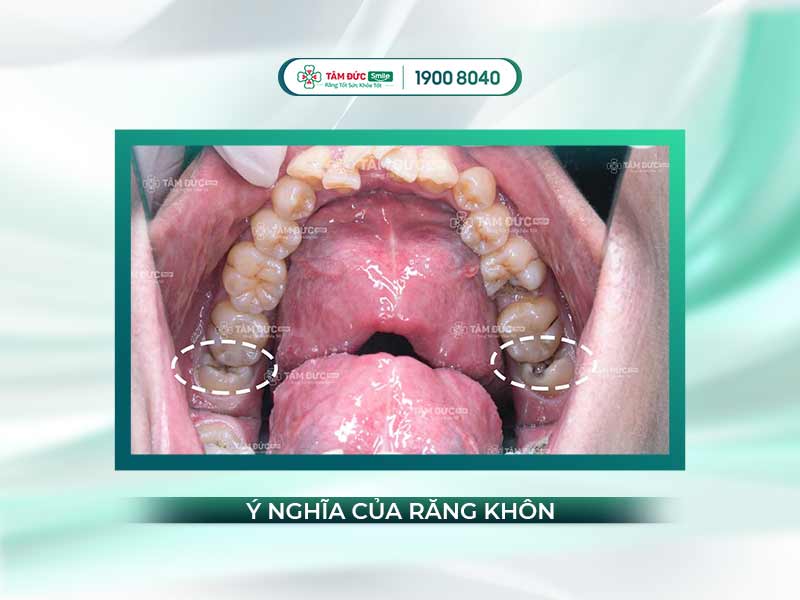 MỌC RĂNG KHÔN CÓ Ý NGHĨA GÌ KHÔNG?