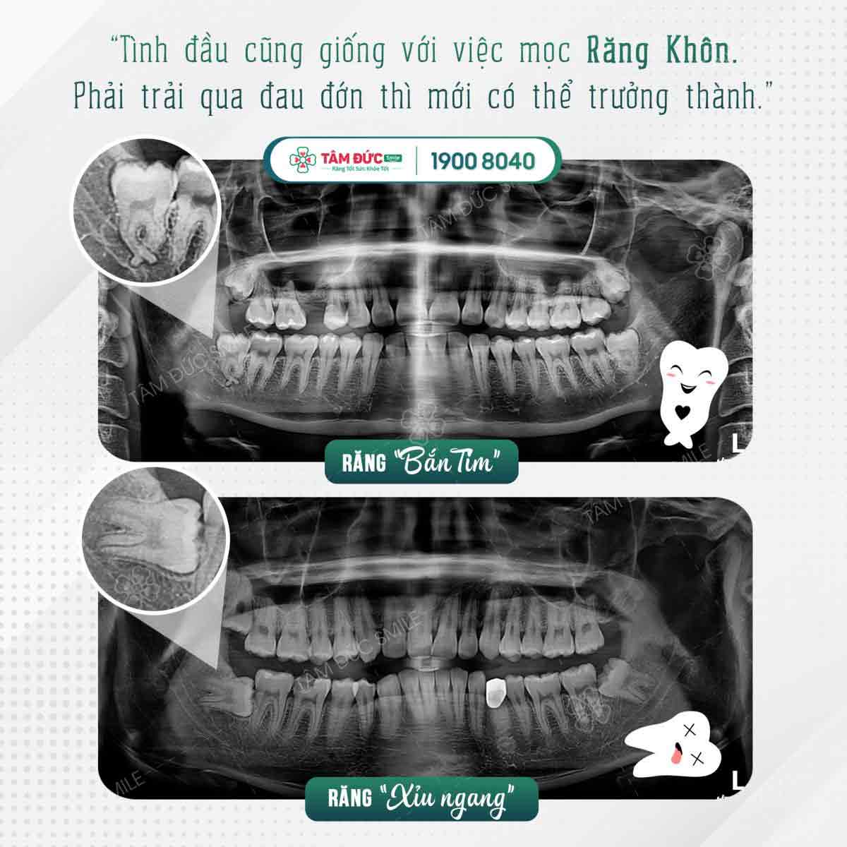 các dạng mọc răng khôn gây đau