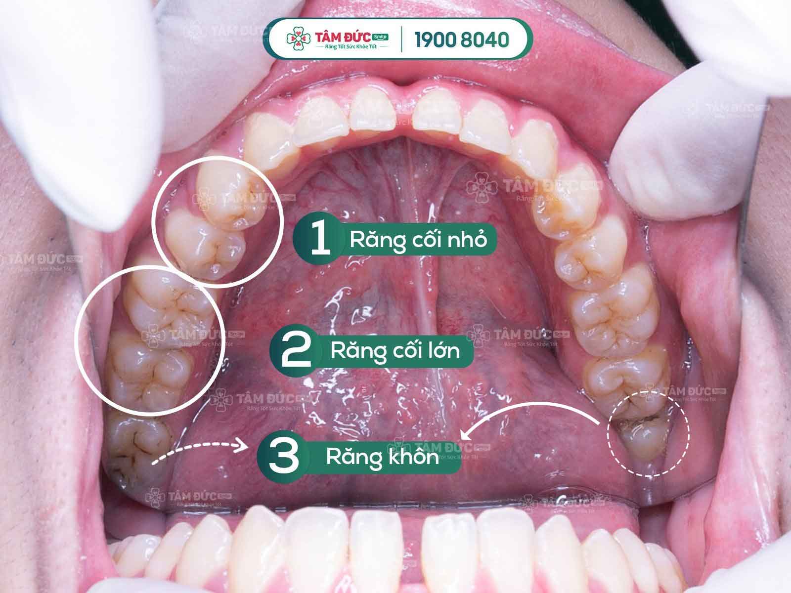 mọc răng khôn lợi trùm răng