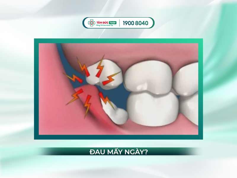 MỌC RĂNG KHÔN ĐAU TRONG BAO LÂU THÌ HẾT?