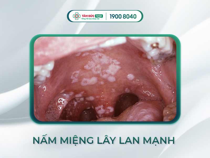  NẤM MIỆNG CÓ LÂY KHÔNG? BẬT MÍ CÁCH PHÒNG TRÁNH LÂY NHIỄM NẤM MIỆNG CỰC HIỆU QUẢ