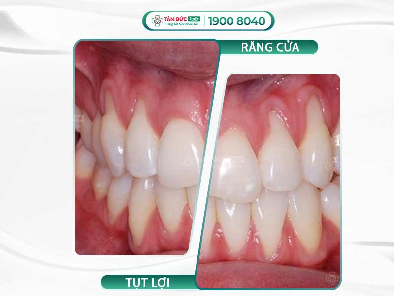 NÊN LÀM GÌ KHI BỊ TỤT LỢI RĂNG CỬA? 5 CÁCH PHÒNG TRÁNH TỤT LỢI HIỆU QUẢ