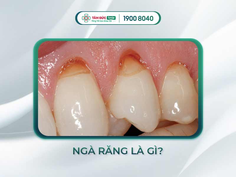 NGÀ RĂNG LÀ GÌ? NGUYÊN NHÂN NGÀ RĂNG BỊ LỘ VÀ CÁCH PHÒNG NGỪA HIỆU QUẢ