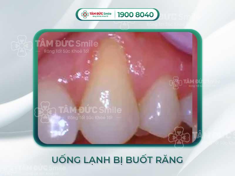 NGUYÊN NHÂN UỐNG NƯỚC LẠNH RĂNG BỊ BUỐT? CÁCH GIẢM BUỐT RĂNG HIỆU QUẢ VÀ AN TOÀN