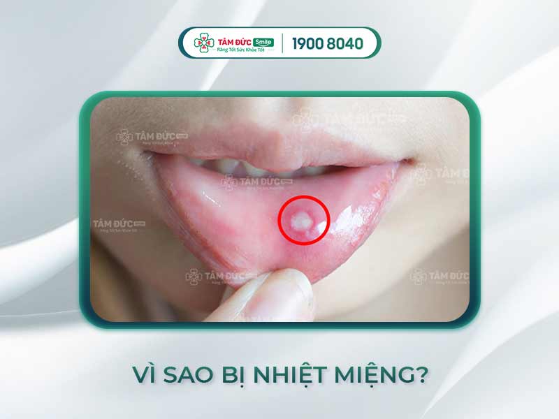NHIỆT MIỆNG LÀ GÌ? CÁCH ĐIỀU TRỊ NHIỆT MIỆNG HIỆU QUẢ, TRÁNH TÁI PHÁT
