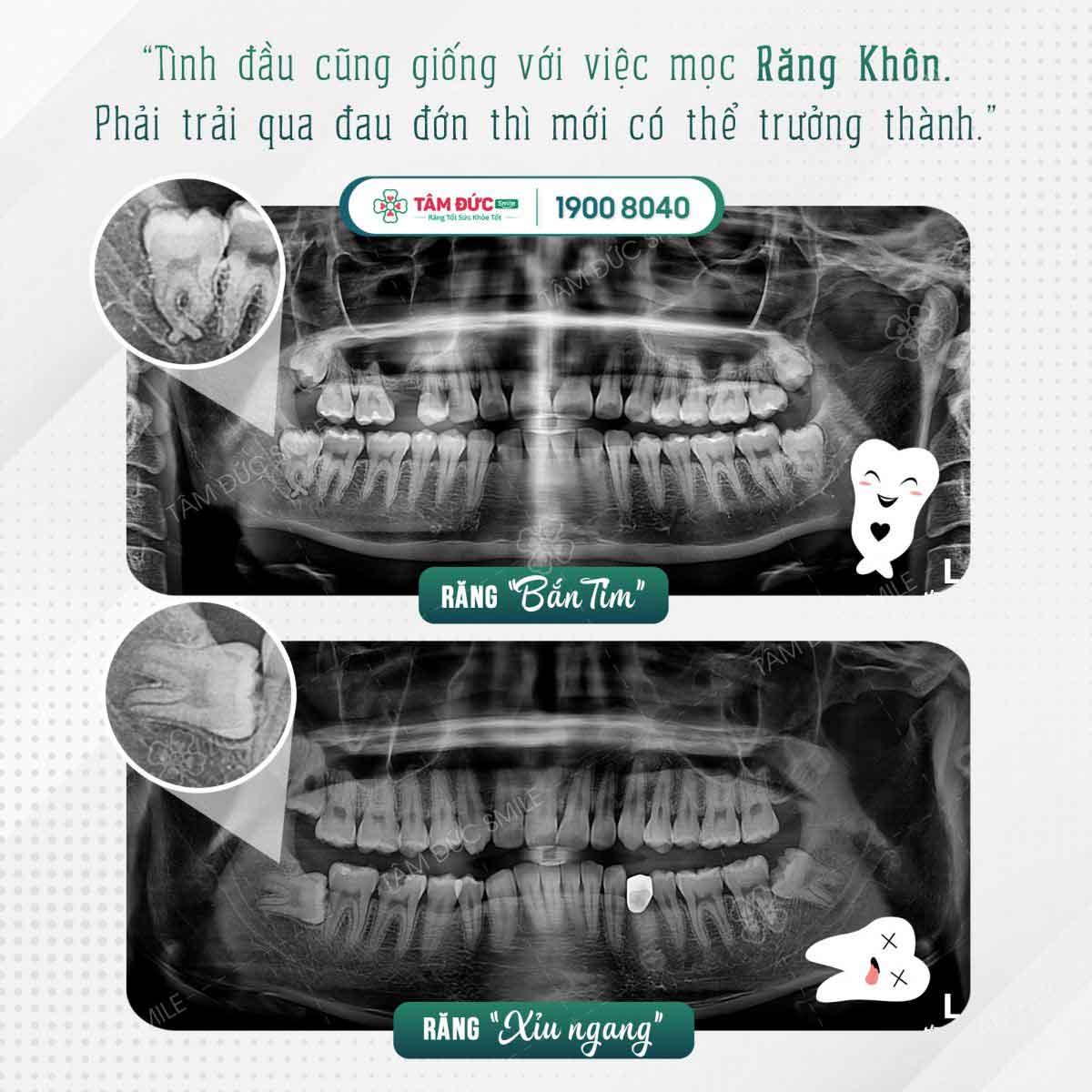 nhổ răng khôn bao lâu thì lành