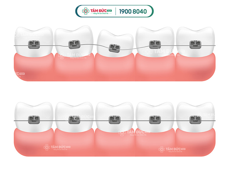 niềng răng mặt trong giá bao nhiêu tiền