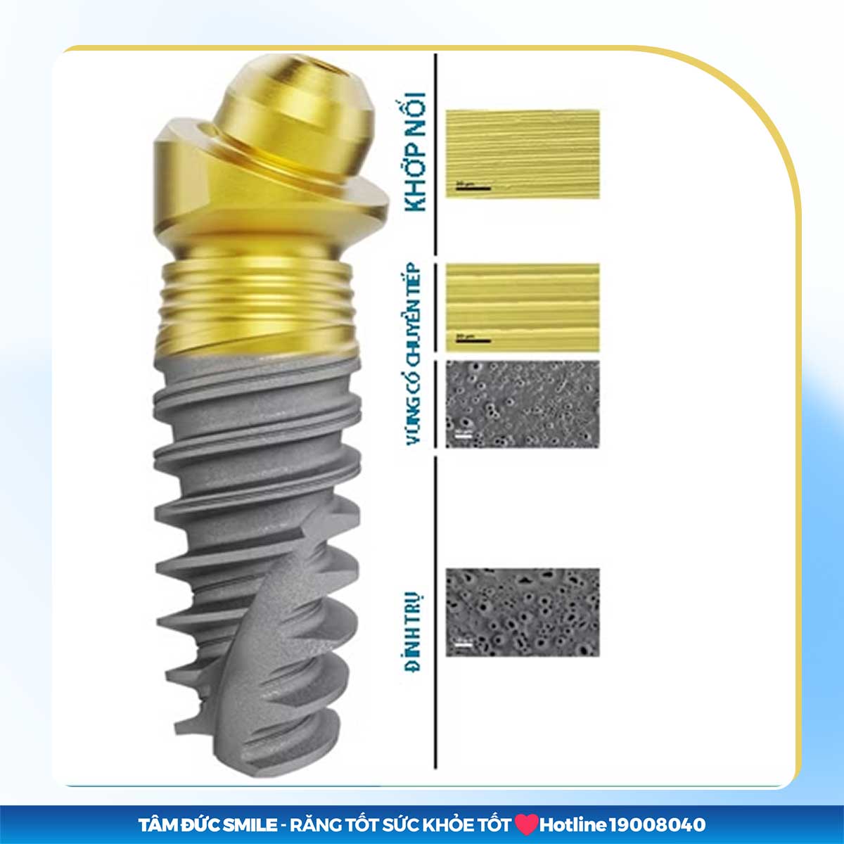 ưu điểm của trụ implant nobel active tiultra