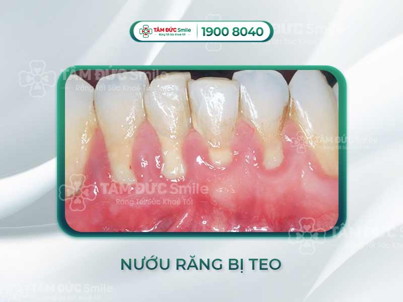 NƯỚU RĂNG BỊ TEO CÓ LÀM SAO KHÔNG? CÁCH KHẮC PHỤC TEO NƯỚU