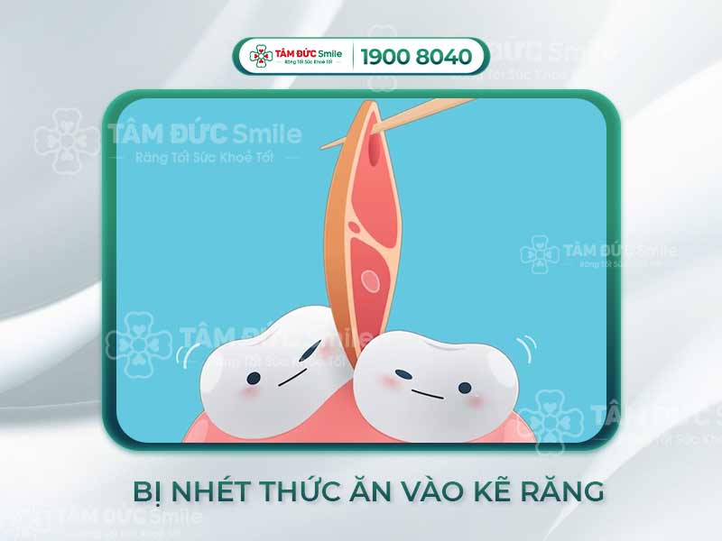 PHẢI LÀM GÌ KHI BỊ NHÉT THỨC ĂN VÀO KẼ RĂNG? NGUYÊN NHÂN VÀ CÁCH XỬ TRÍ PHÙ HỢP