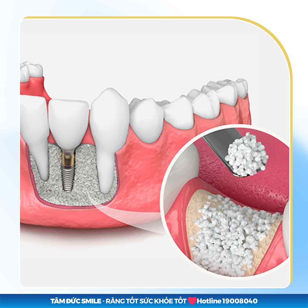 PHẪU THUẬT GHÉP XƯƠNG HÀM CẤY IMPLANT CÓ ĐAU KHÔNG?