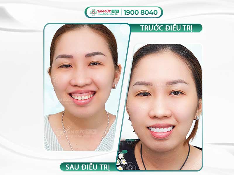 PHẪU THUẬT NƯỚU RĂNG ĐIỀU TRỊ CƯỜI HỞ LỢI TẠI TÂM ĐỨC SMILE