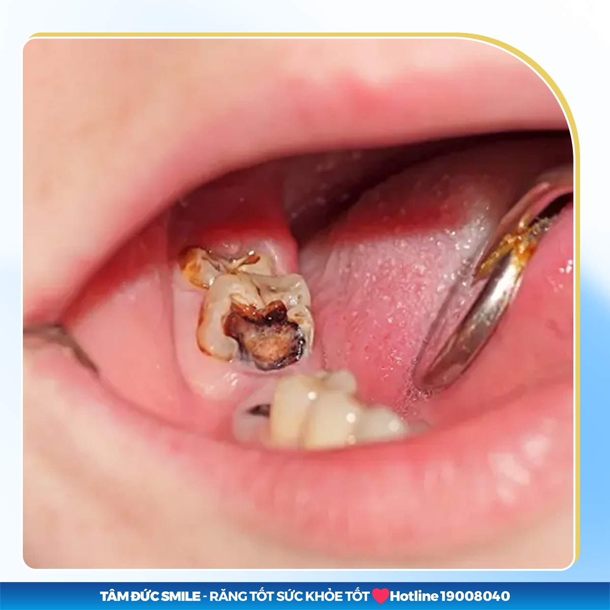 trồng răng hàm bị sâu