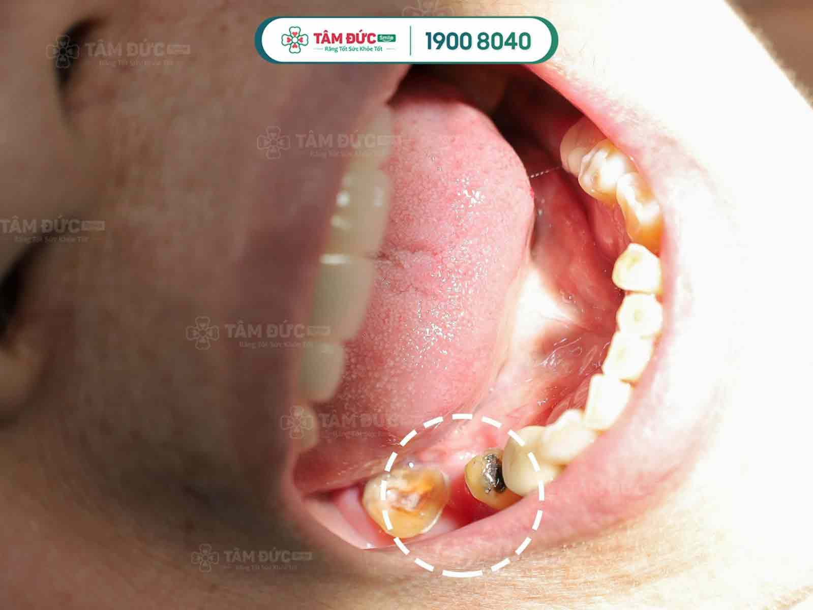 răng bị sâu ăn mòn hết chỉ còn chân răng