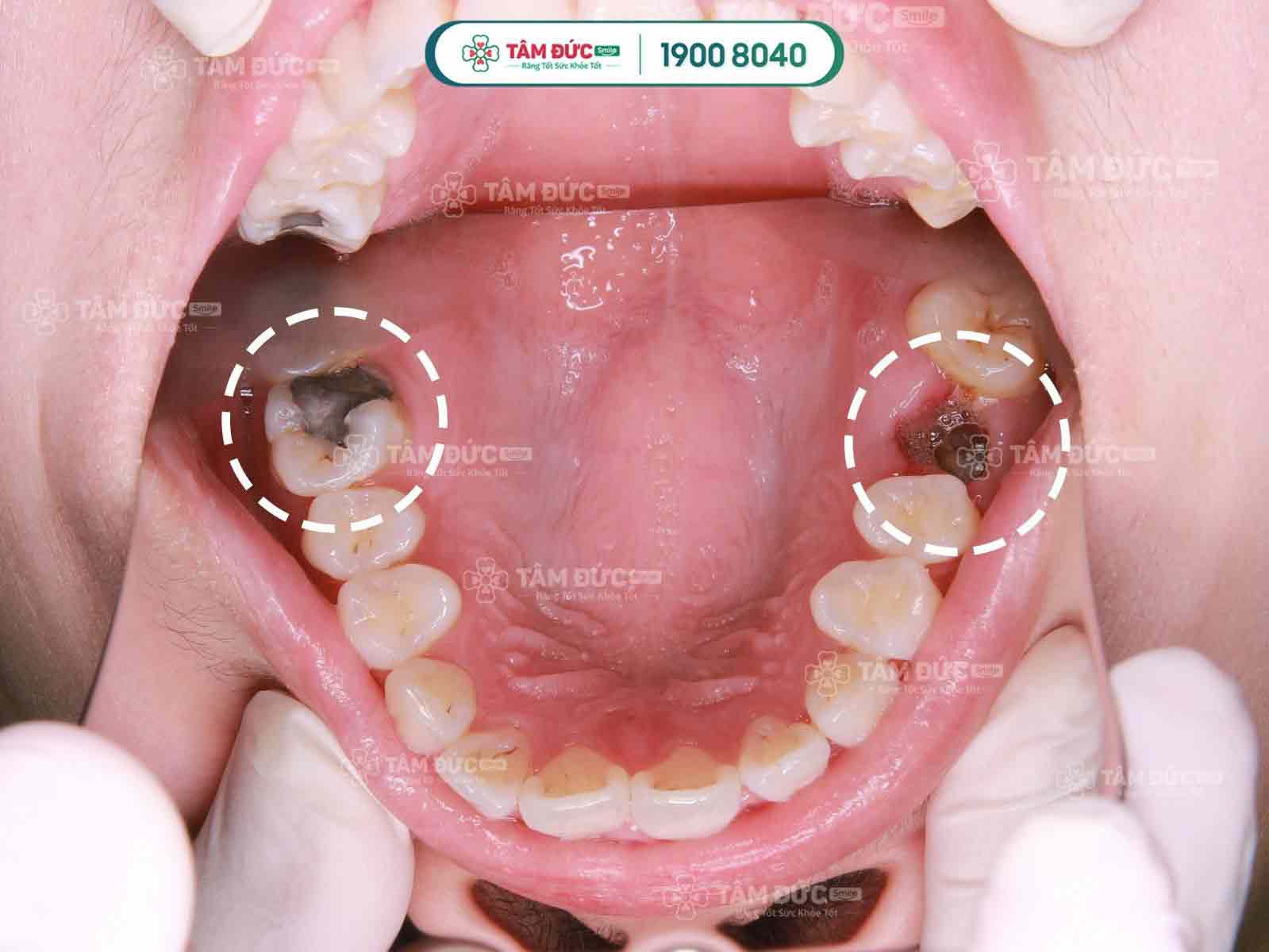 răng bị sâu ăn mòn hết chỉ còn chân răng