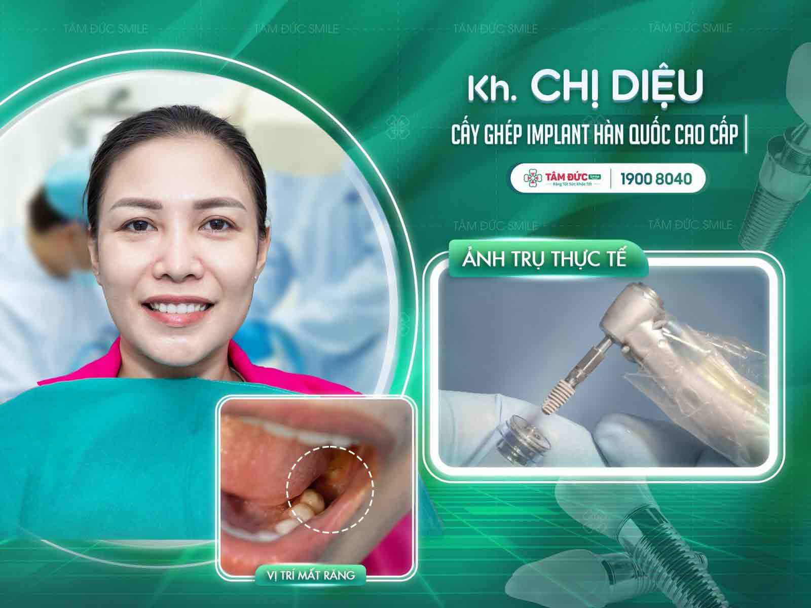 chị Minh Hoàng sau khi cấy Implant tại nha khoa Tâm Đức Smile