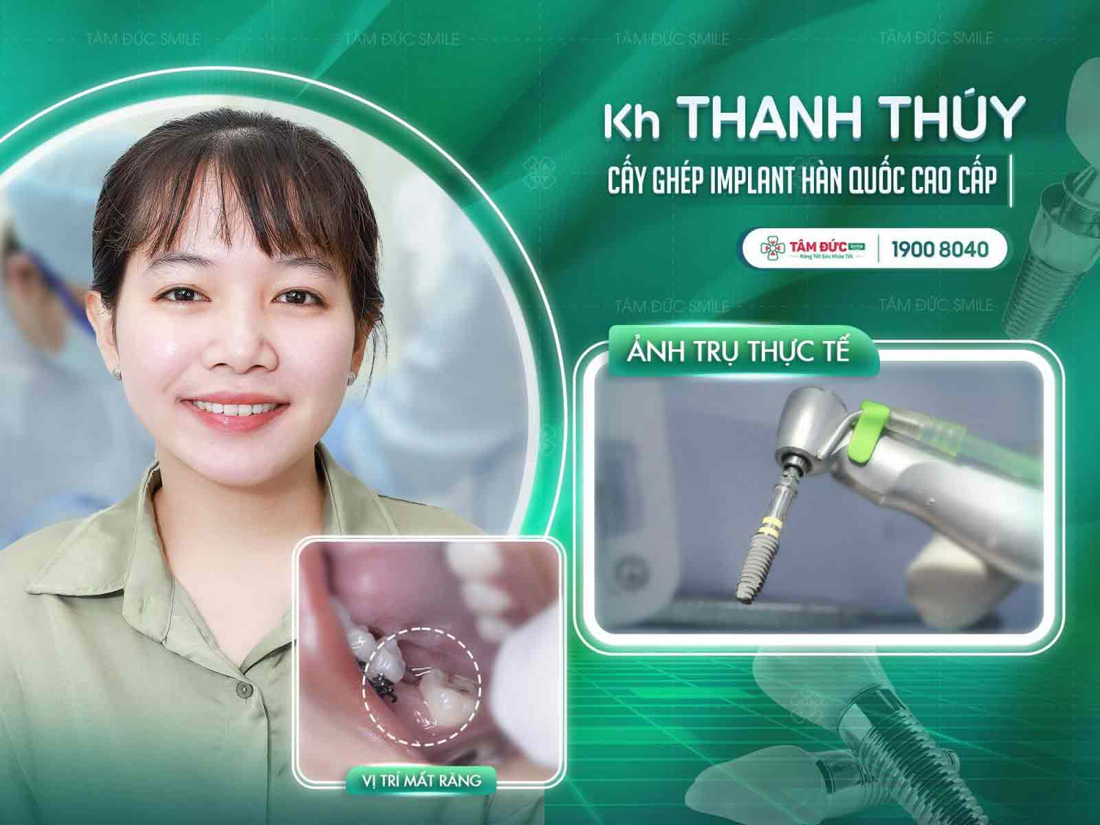 chị Thuý sau khi cấy Implant tại nha khoa Tâm Đức Smile