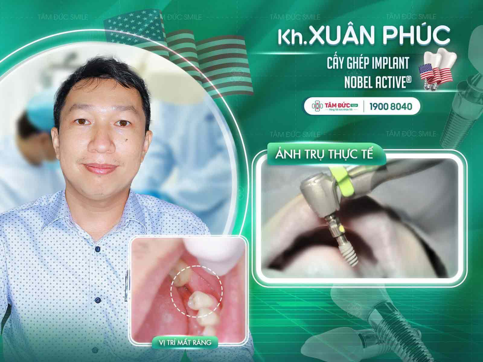 răng bị sâu ăn mòn hết không thể giữ lại