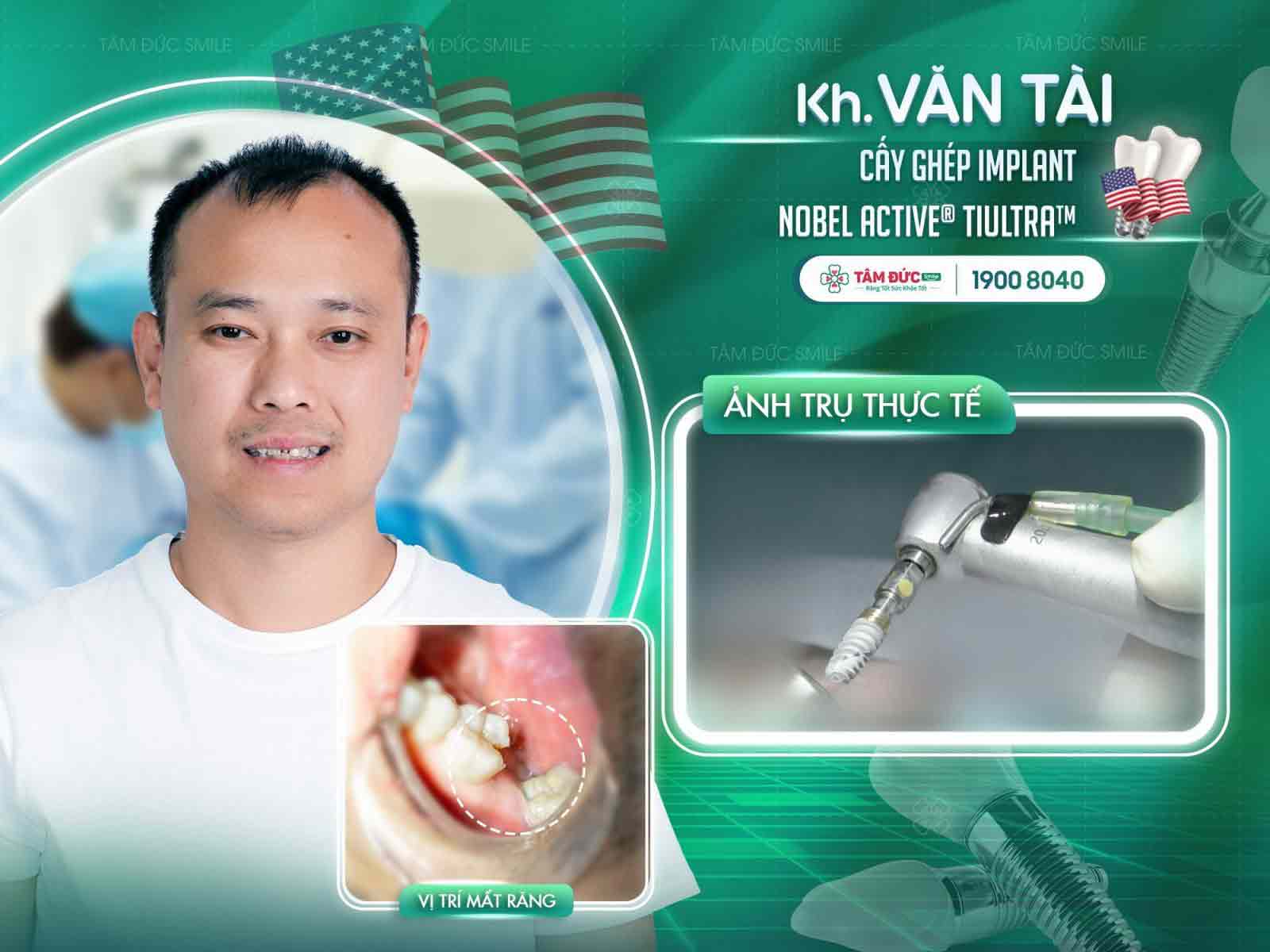 răng bị sâu ăn mòn hết sau khi cắm implant