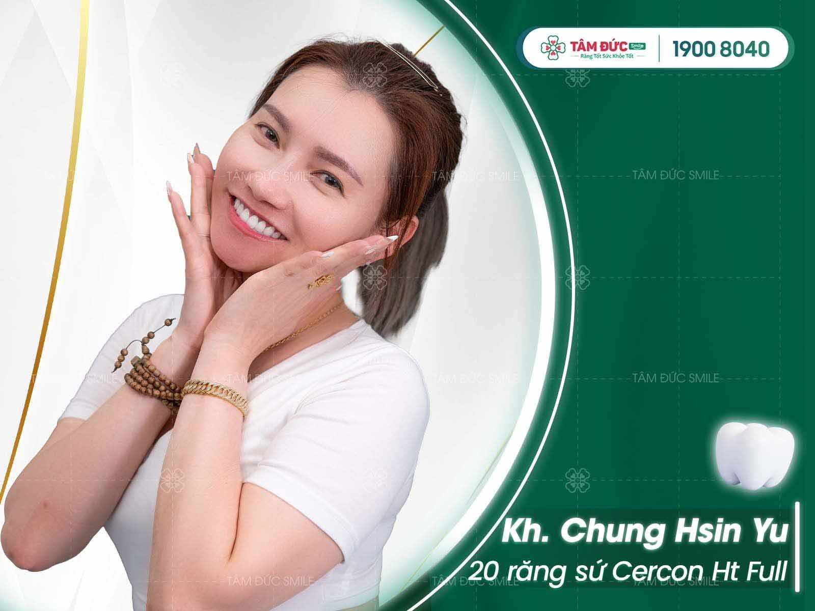 Chị Yu sau khi bọc sứ răng cối tại nha khoa Tâm Đức Smile