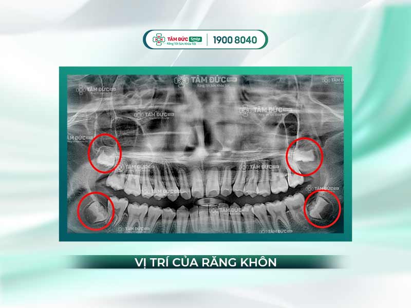 RĂNG NÀO LÀ RĂNG KHÔN? QUY TẮC ĐÁNH SỐ RĂNG TRÊN CUNG HÀM