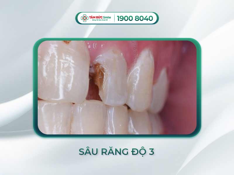 RĂNG SÂU ĐỘ 3 LÀ NHƯ THẾ NÀO? PHƯƠNG PHÁP ĐIỀU TRỊ DỨT ĐIỂM SÂU RĂNG MỨC 3