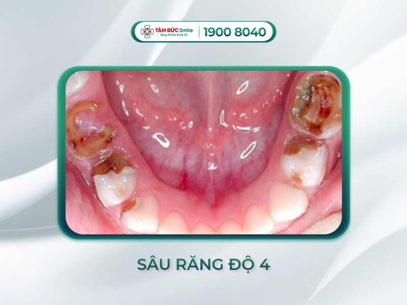 RĂNG SÂU ĐỘ 4 LÀ NHƯ THẾ NÀO? CÁCH XỬ LÝ DỨT ĐIỂM SÂU RĂNG MỨC 4