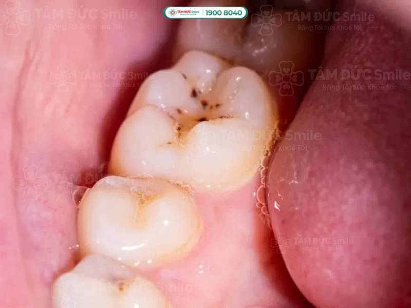 sâu răng là gì? sâu răng cấp độ 1