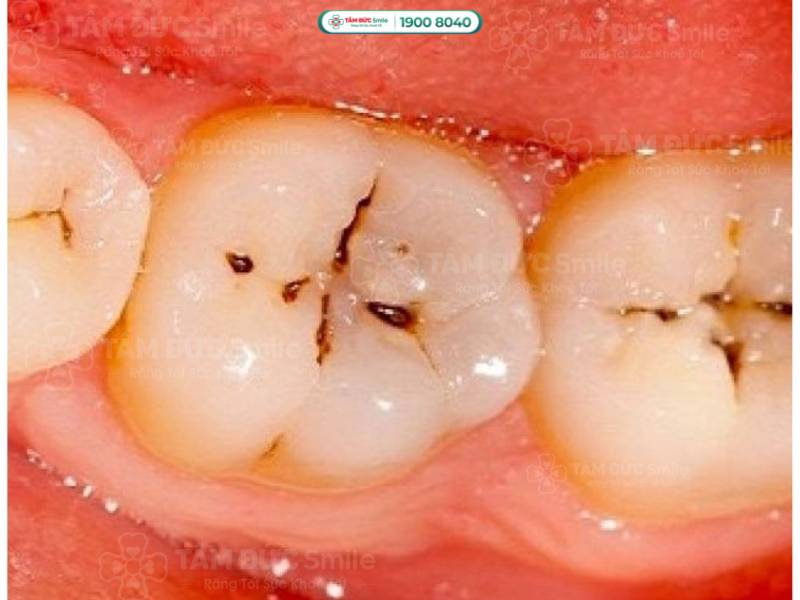 sâu răng là gì? sâu răng cấp độ 2