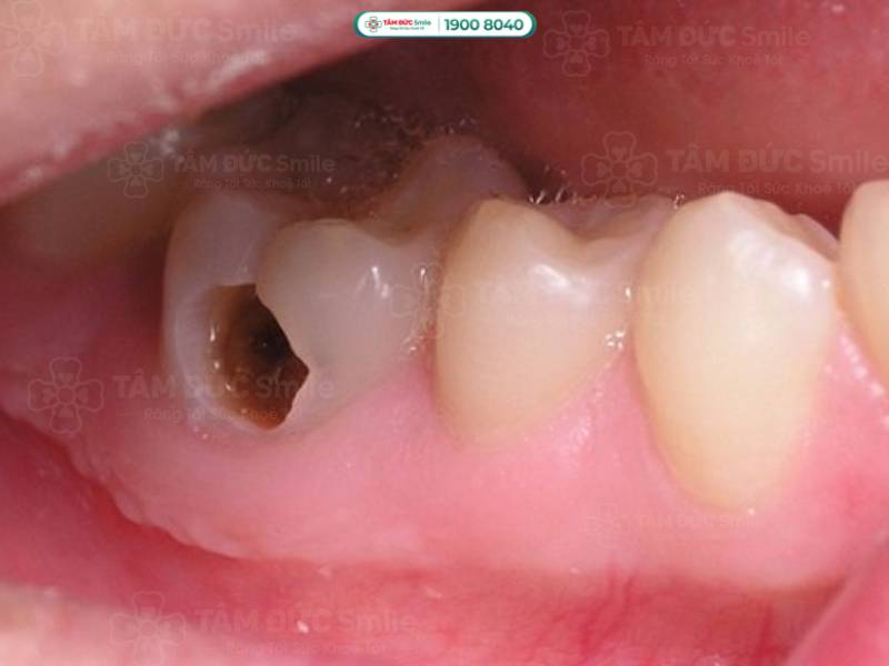 sâu răng là gì? sâu răng cấp độ 3