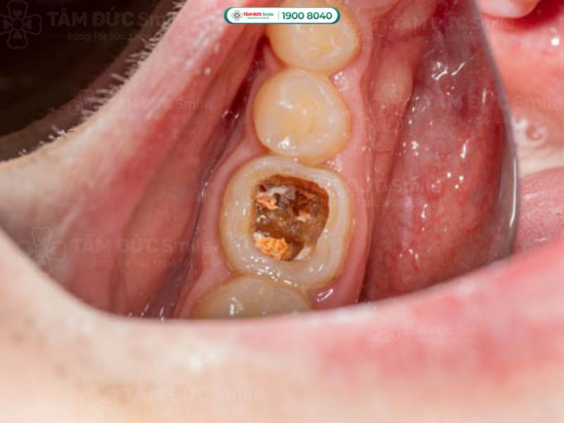 sâu răng là gì? sâu răng cấp độ 4