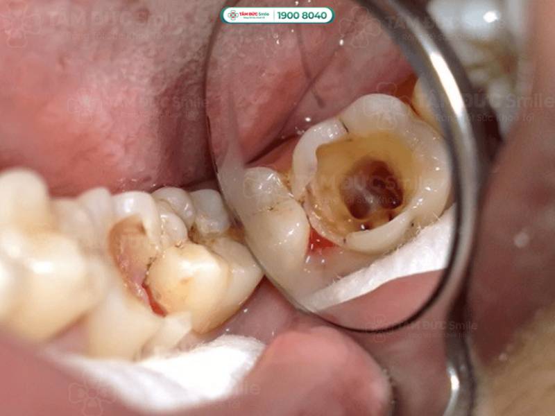 sâu răng là gì? khi sâu răng nặng gây hoại tử tủy