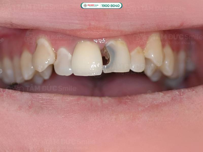 sâu răng là gì? sâu răng cửa ảnh hưởng nụ cười như thế nào