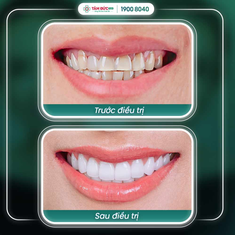 hình ảnh răng sứ trước và sau khi điều trị ố vàng