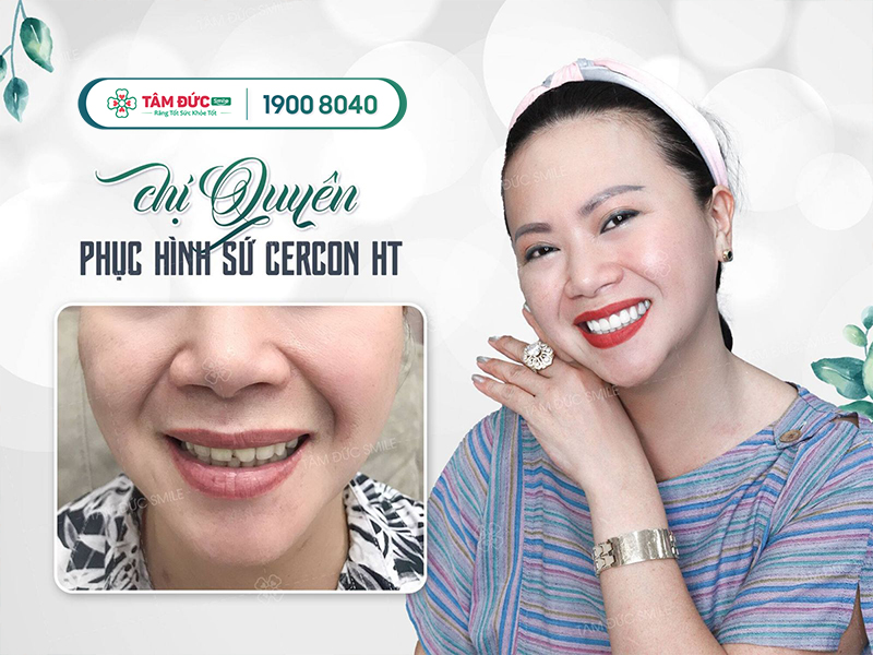 Răng Sứ Cercon Ht Mỹ - Đỉnh Cao Răng Sứ Cao Cấp